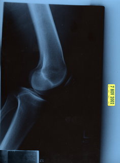 Adam's knee X-ray 1