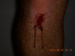 Adam's knee X-ray 1