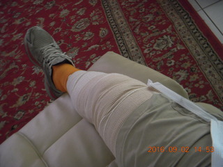 Adam's knee X-ray 1