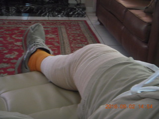 Adam's knee X-ray 1