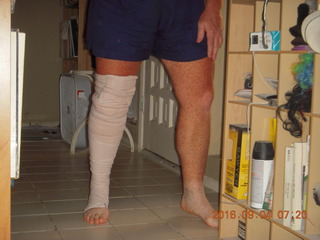 two days after my knee surgery