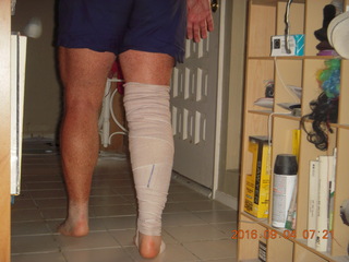 two days after my knee surgery
