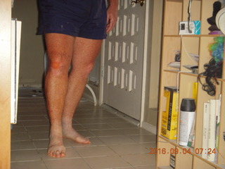 after knee operation + Adam