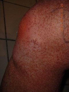 two days after my knee surgery
