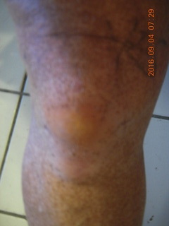 two days after my knee surgery