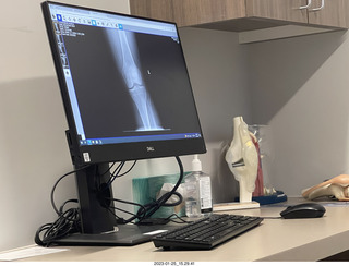 two days after my knee surgery